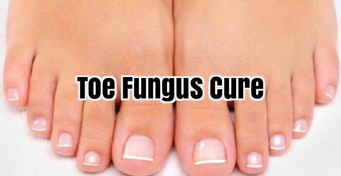 Toe Fungus Cure
