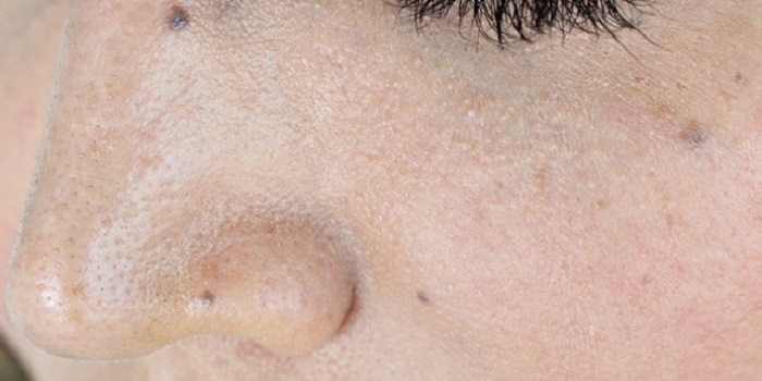 What Is A Pore Minimizer