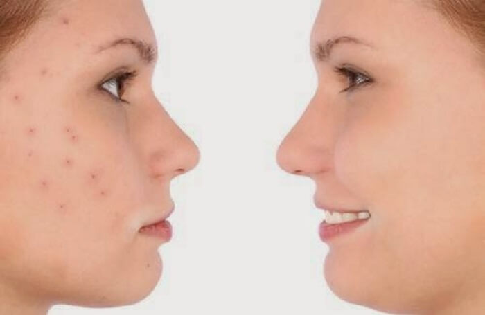 Home Remedies For Pores