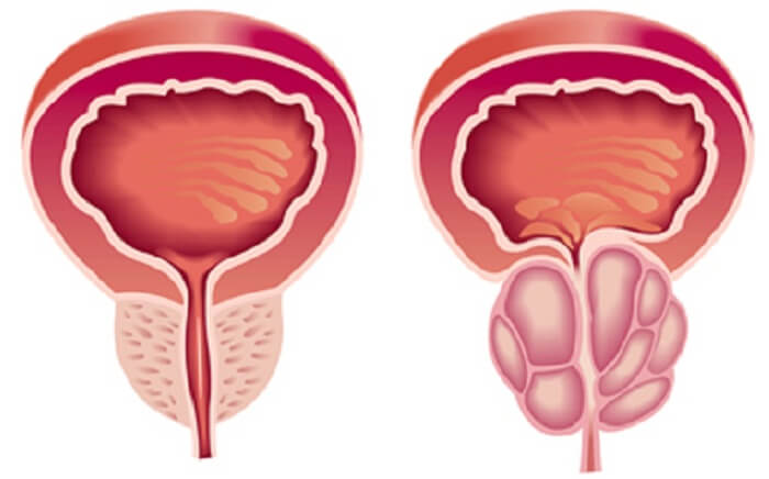 Home Remedies For Prostatitis
