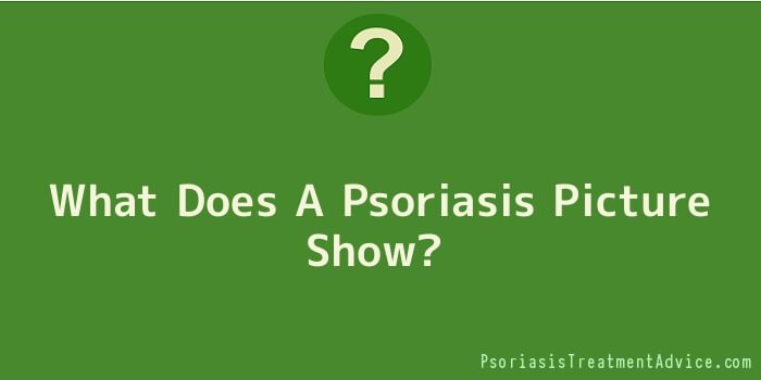 What Does A Psoriasis Picture Show