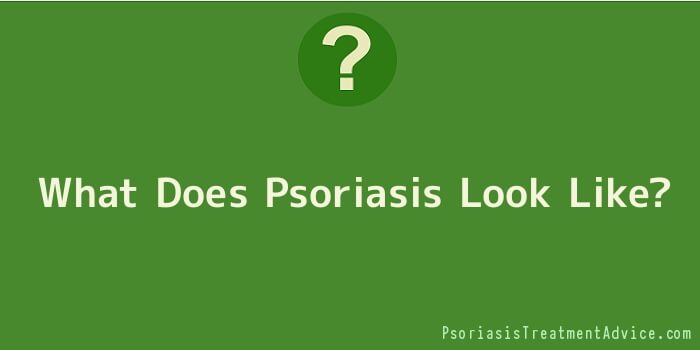 What Does Psoriasis Look Like