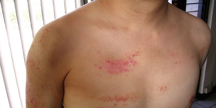The Best Ways To Treat Psoriasis