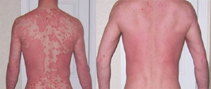 What Are Great Treatments For Psoriasis