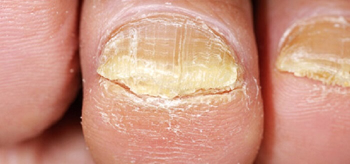 Toe Nail Psoriasis Treatment