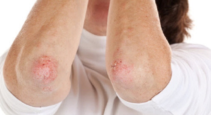Home Remedies For Psoriasis