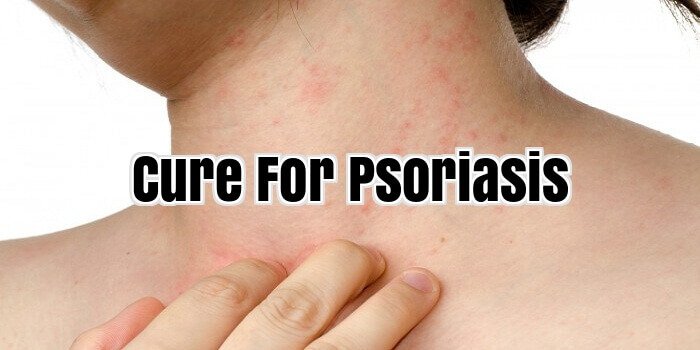 Cure For Psoriasis