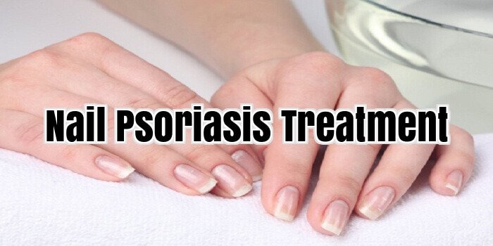 Nail Psoriasis Treatment