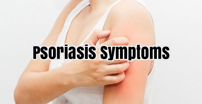 Psoriasis Symptoms