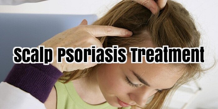 Scalp Psoriasis Treatment