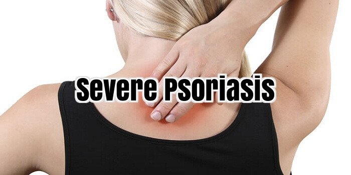 Severe Psoriasis