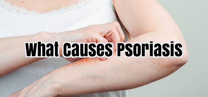 What Causes Psoriasis