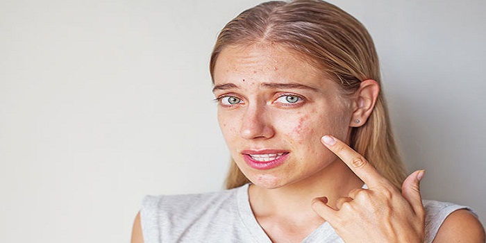Tips On How To Deal With Rosacea Breakouts