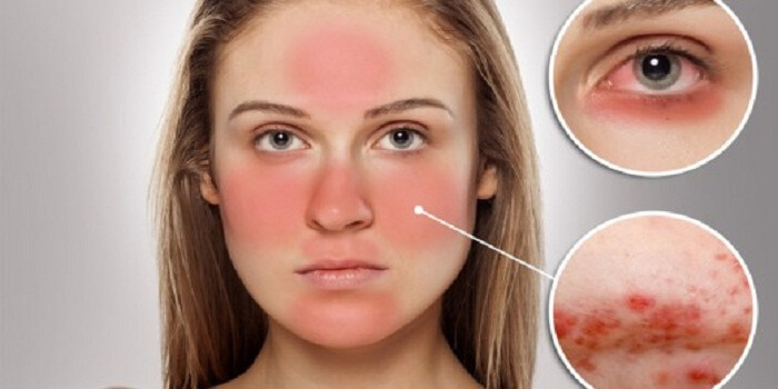 Great, Good Feelings With Rosacea Treatment
