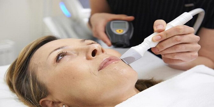 How To Treat Rosacea Without Consulting A Physician?