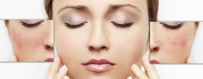 Rosacea Treatments - Over the Counter