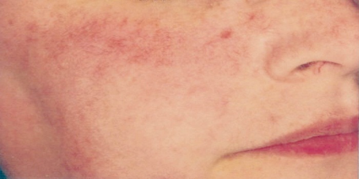 Phases Of Rosacea and Early Diagnosis