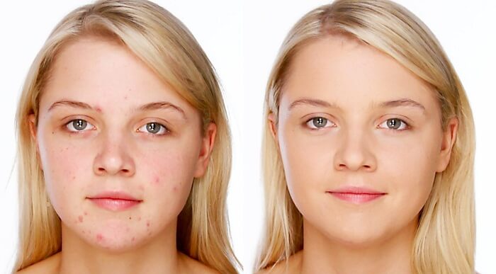 Home Remedies For Rosacea