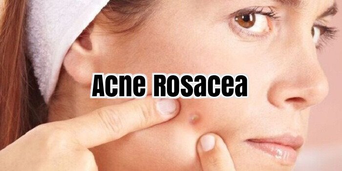 Acne Rosacea