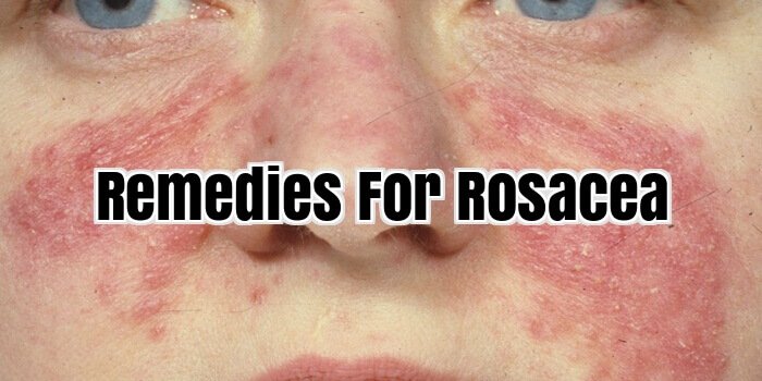 Remedies For Rosacea