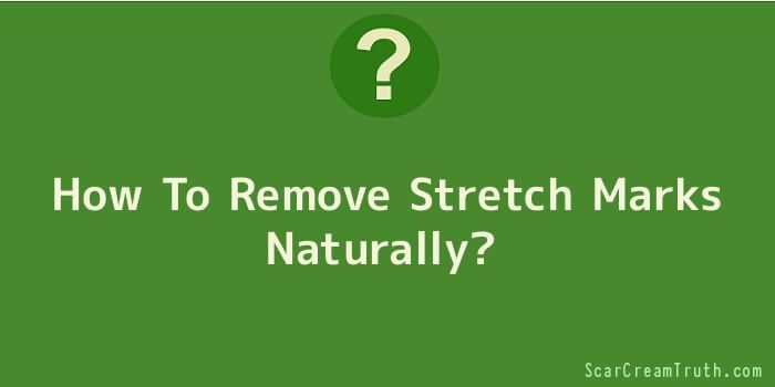 How To Remove Stretch Marks Naturally