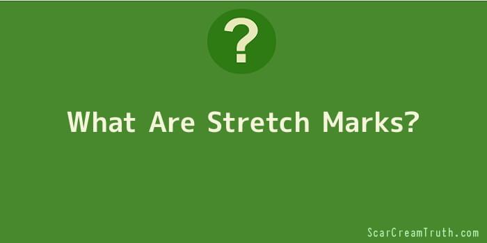 What Are Stretch Marks