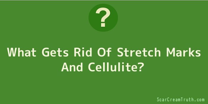 What Gets Rid Of Stretch Marks And Cellulite