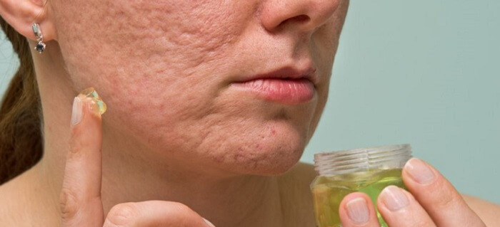 Acne Scar Removal Cream