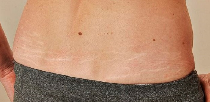 Effective Methods For Mole Removal And Stretch Mark Treatment