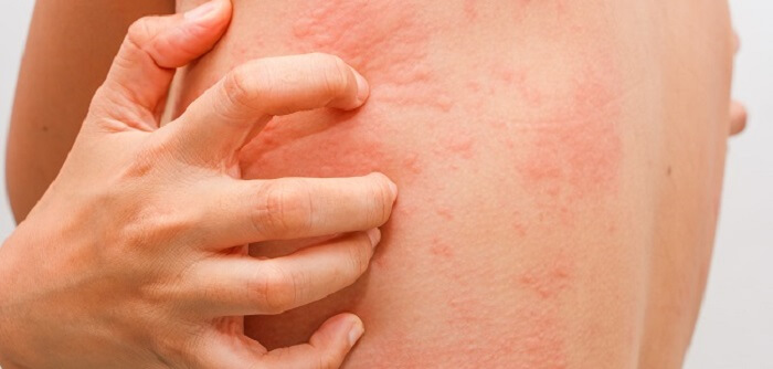 Treatment For Hives
