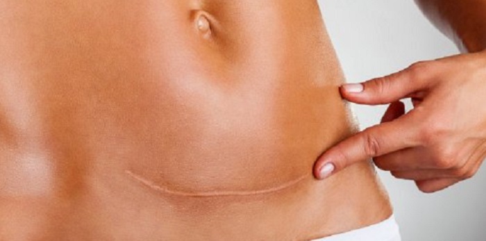 Natural Scar Removal Cream That Can Treat Burns