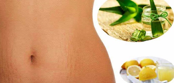 Effective and Natural Stretch Mark Removal For Stretch Marks