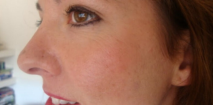 How To Know The Best Scar Cream For Piercing Scars