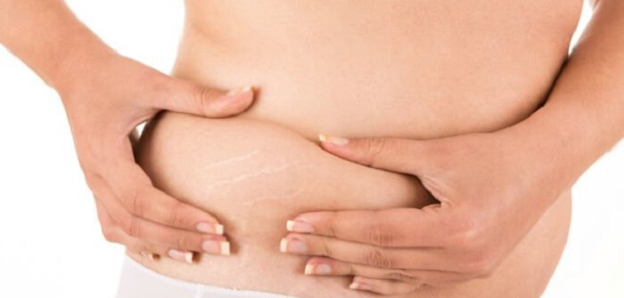 A New Way Of Stretch Mark Removal
