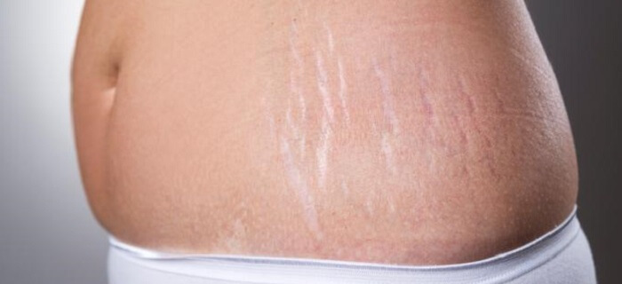 Stretch Mark Removal