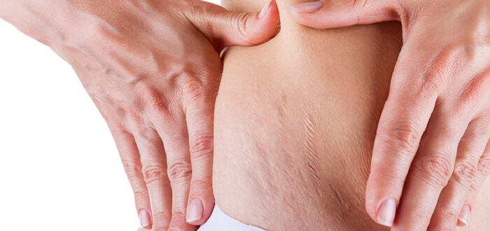 BEST STRETCH MARK REMOVERS Information As Stretch Mark Solution