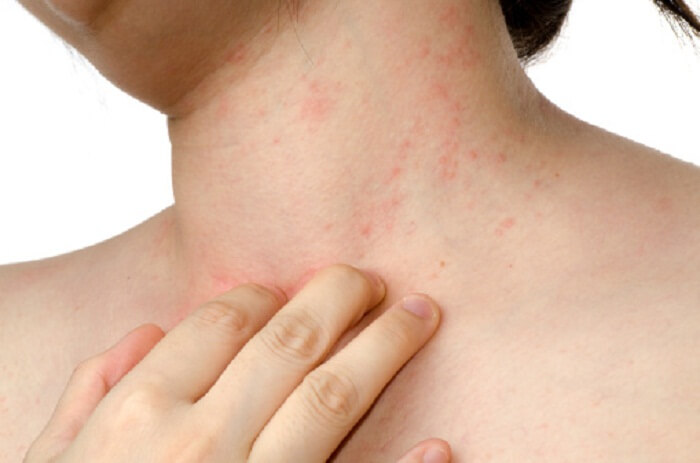 Home Remedies For Hives