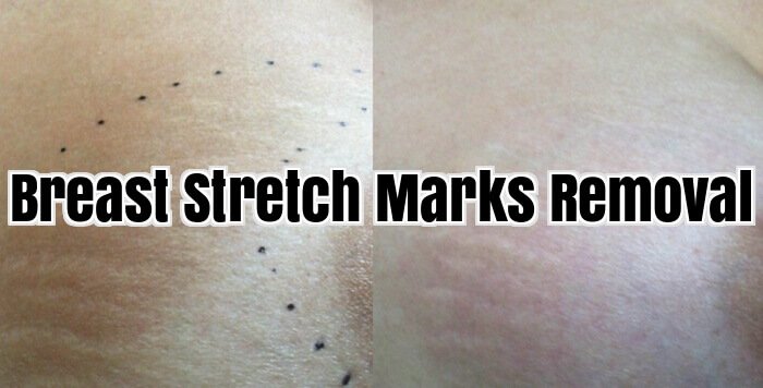 Breast Stretch Marks Removal