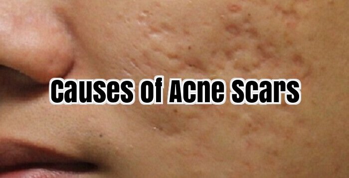 Causes of Acne Scars