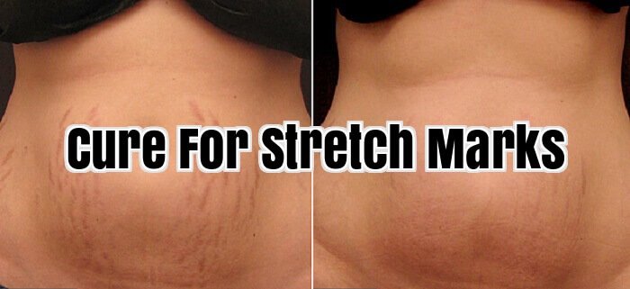 Cure For Stretch Marks