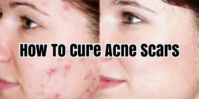 How To Cure Acne Scars