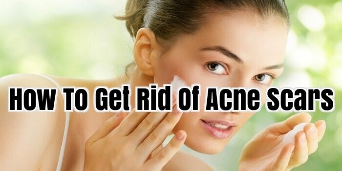 How To Get Rid Of Acne Scars