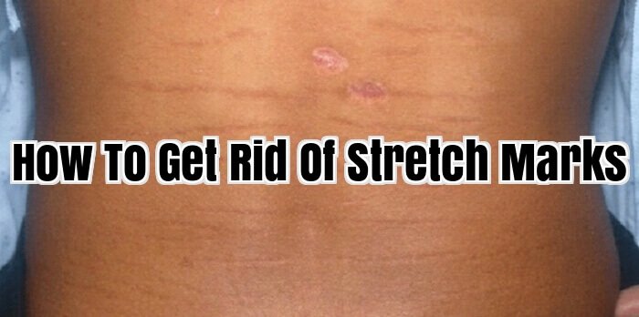 How To Get Rid Of Stretch Marks
