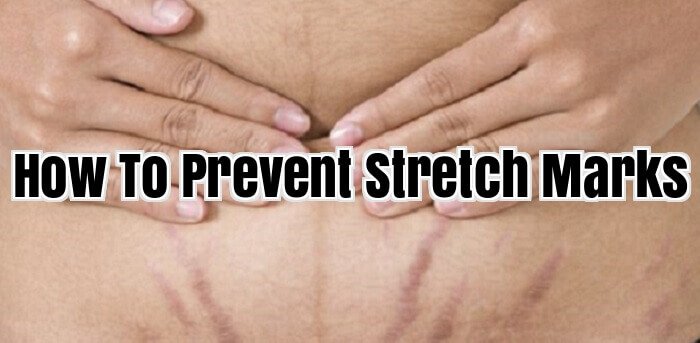 How To Prevent Stretch Marks