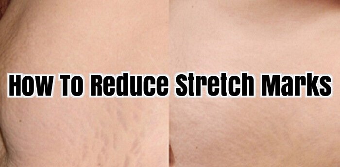 How To Reduce Stretch Marks