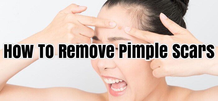 How To Remove Pimple Scars