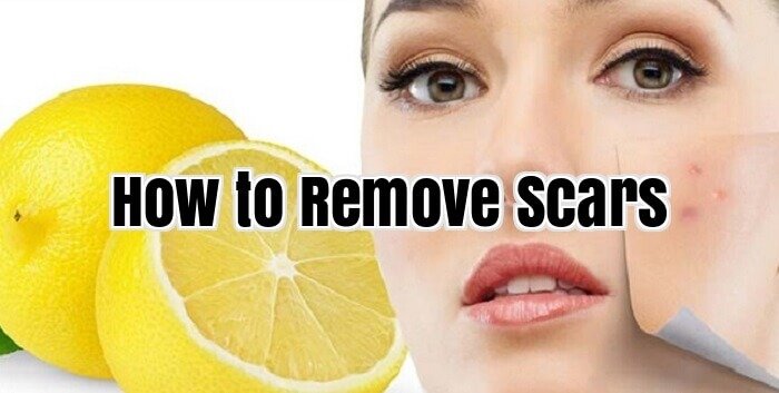 How to Remove Scars