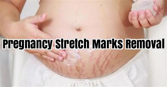 Pregnancy Stretch Marks Removal