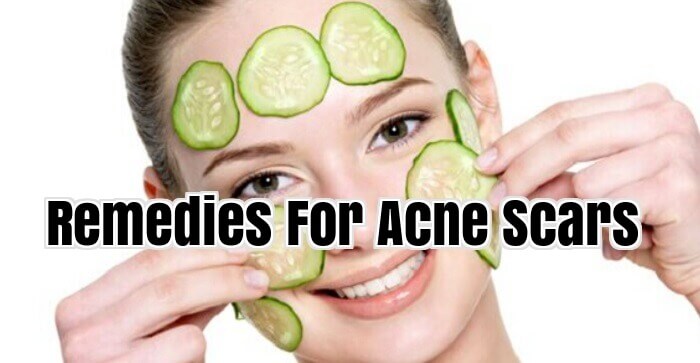 Remedies For Acne Scars
