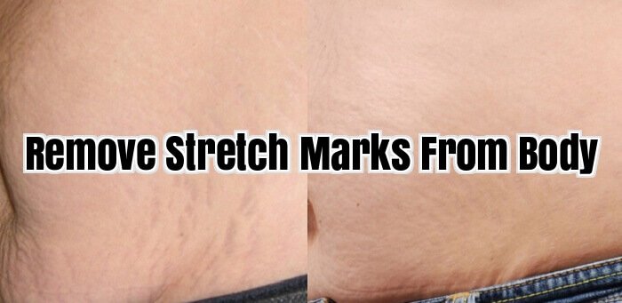 Remove Stretch Marks From Body